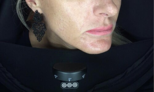 Hialuronsavas Arcszobrászat Skinbooster